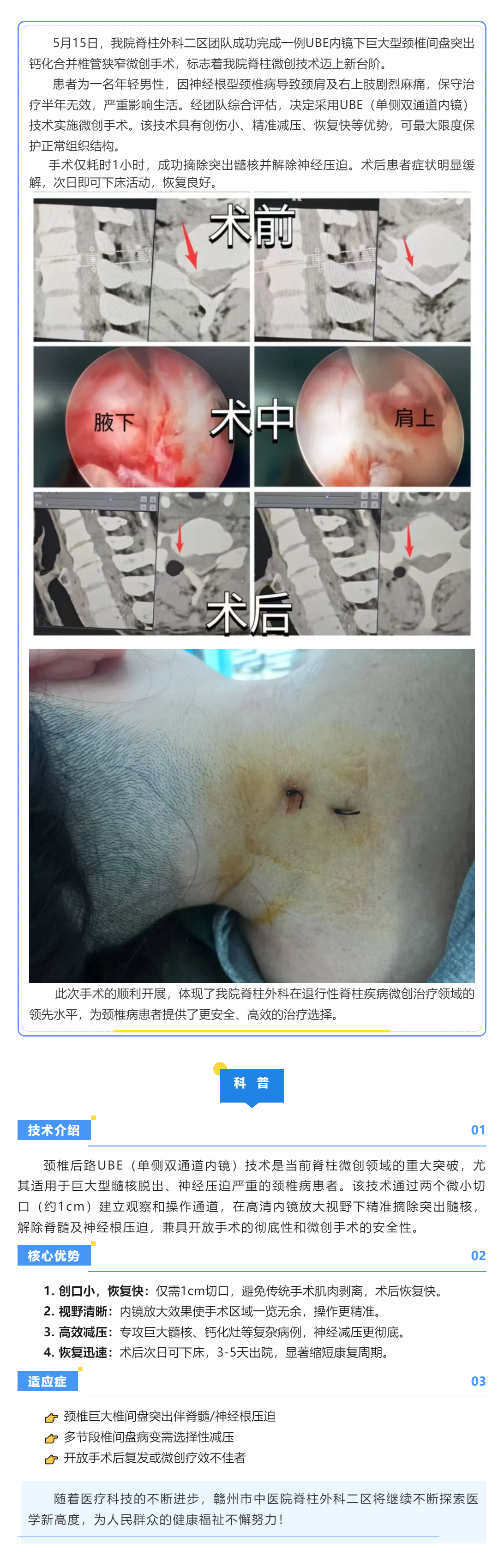 當天手術(shù)→次日下床：UBE技術(shù)讓頸椎病康復快3倍！.png